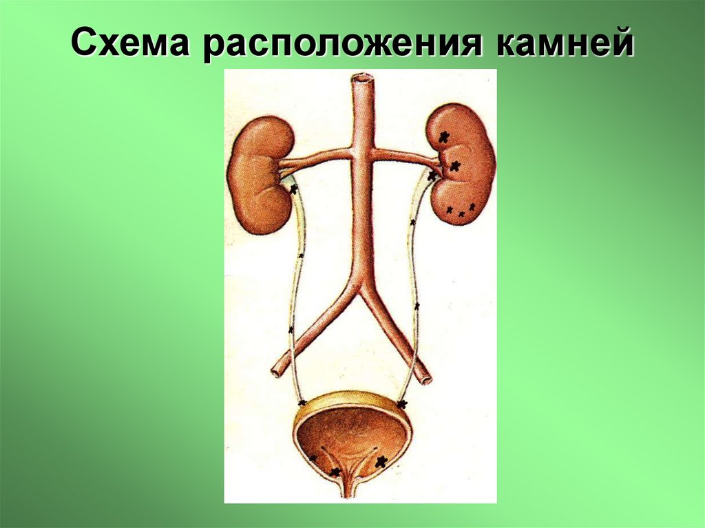 Схема расположения камней