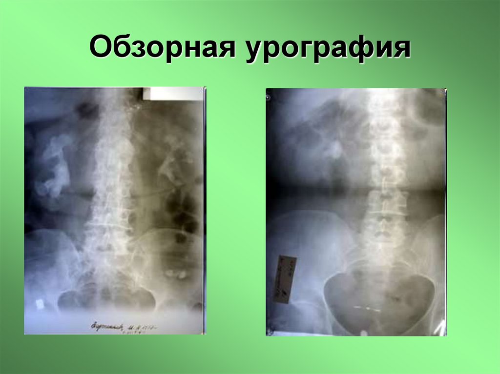 Обзорная урография