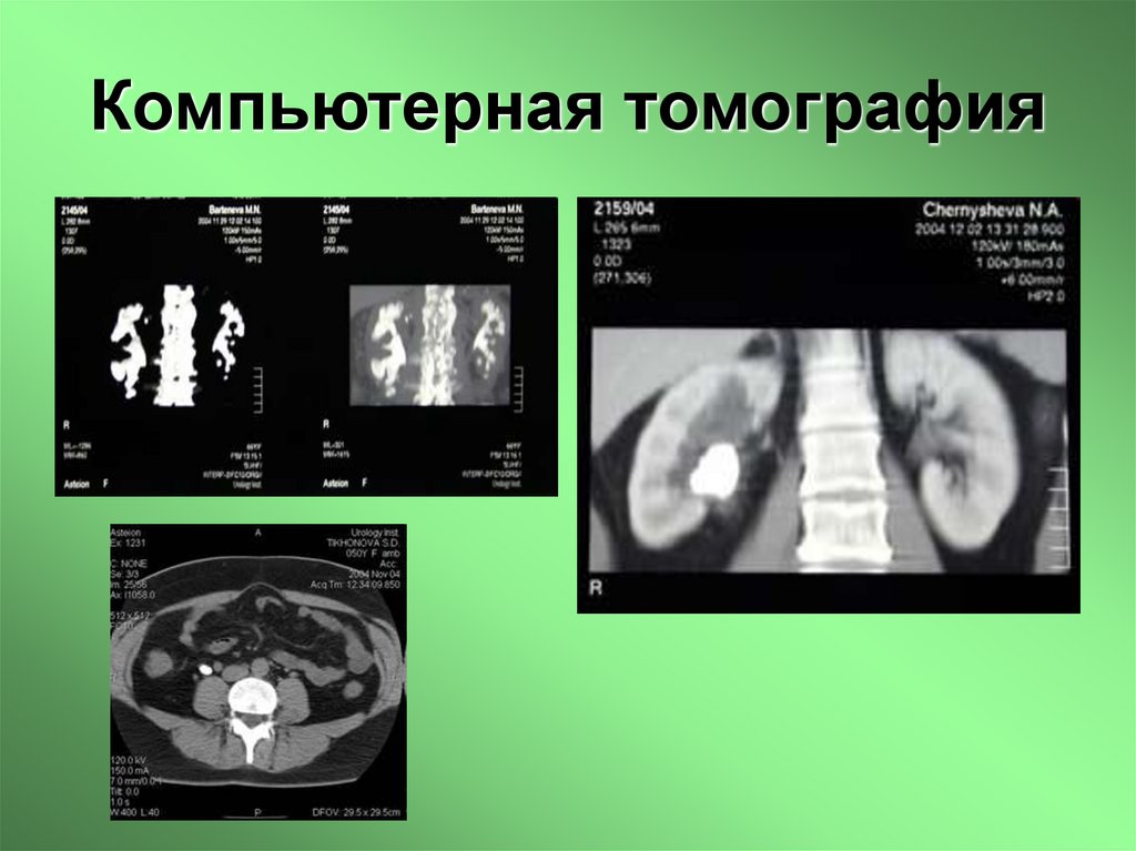 Компьютерная томография