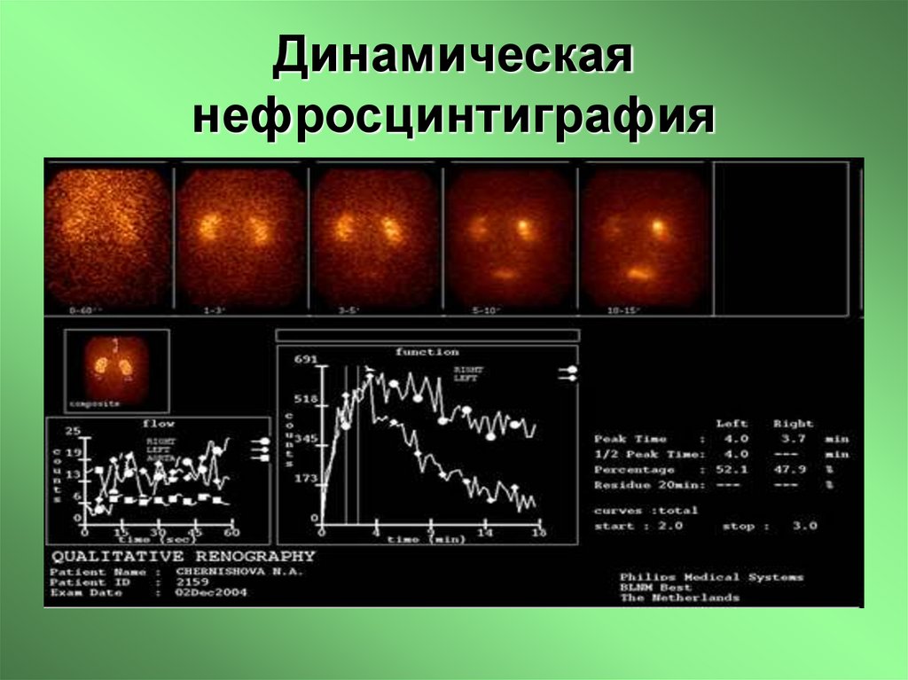 Динамическая нефросцинтиграфия