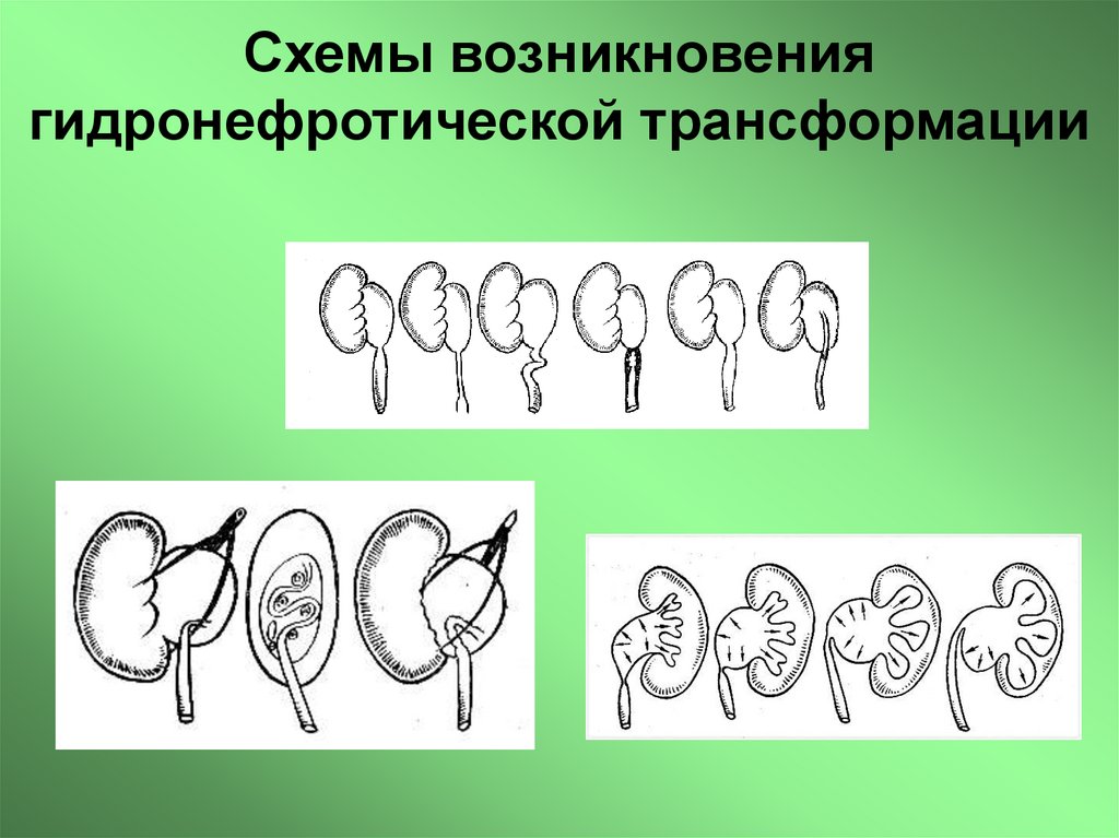 Схемы возникновения гидронефротической трансформации