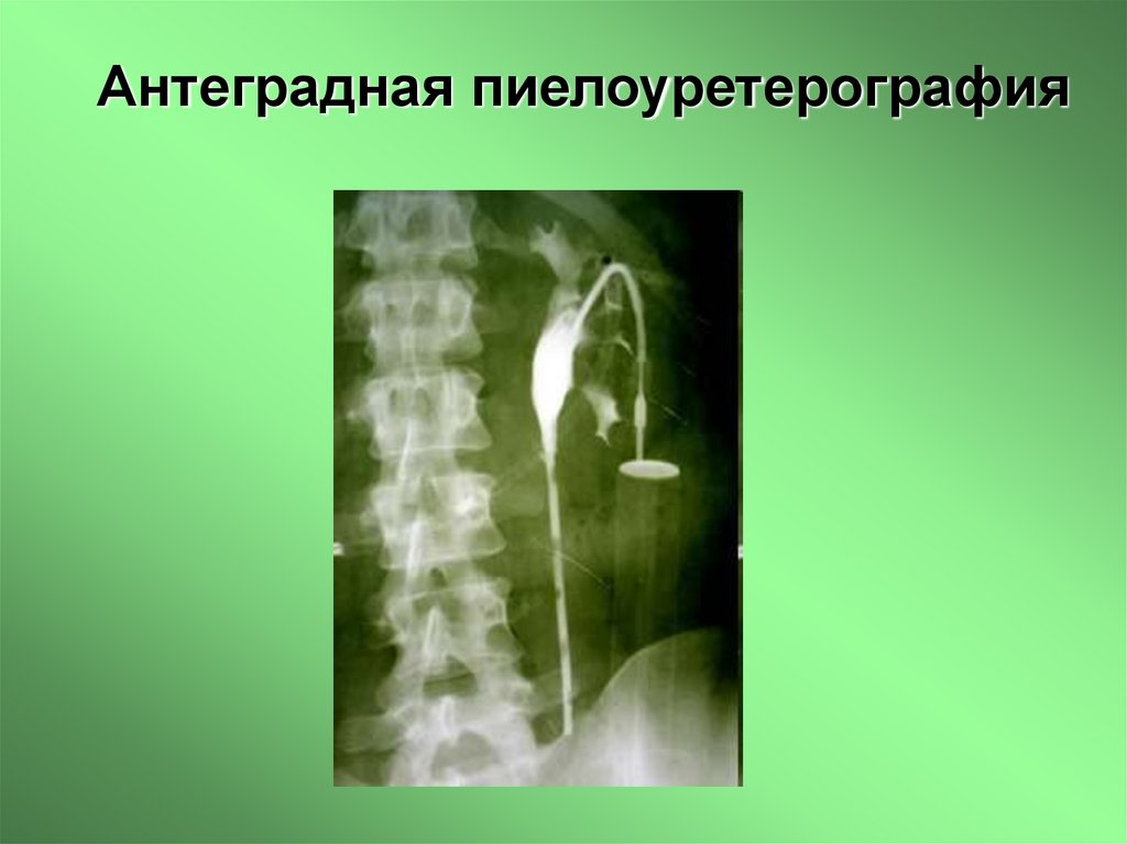 Антеградная пиелоуретерография