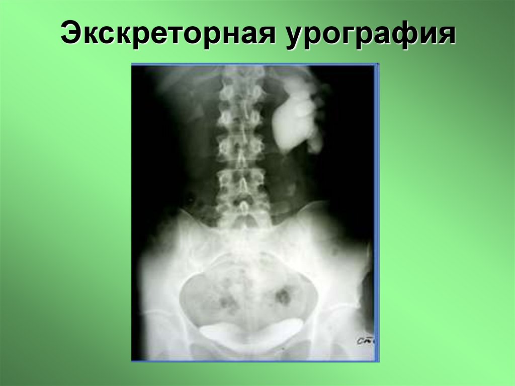 Экскреторная урография