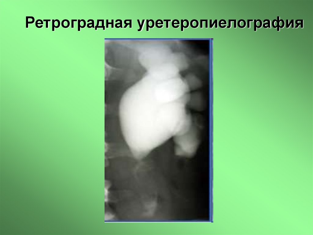 Ретроградная уретеропиелография