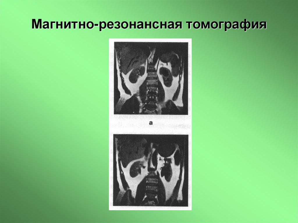 Магнитно-резонансная томография