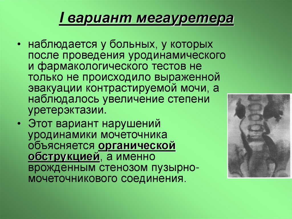 I вариант мегауретера