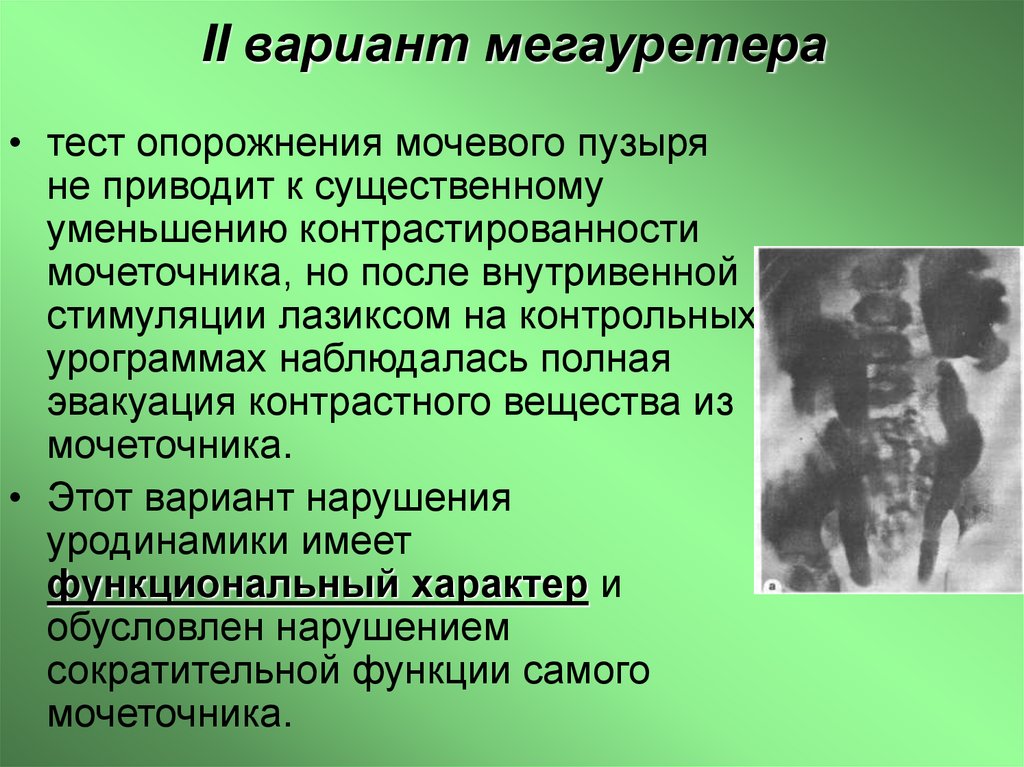 II вариант мегауретера