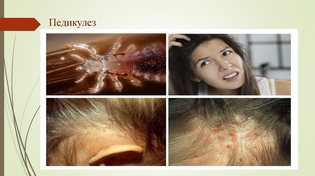 Педикулез