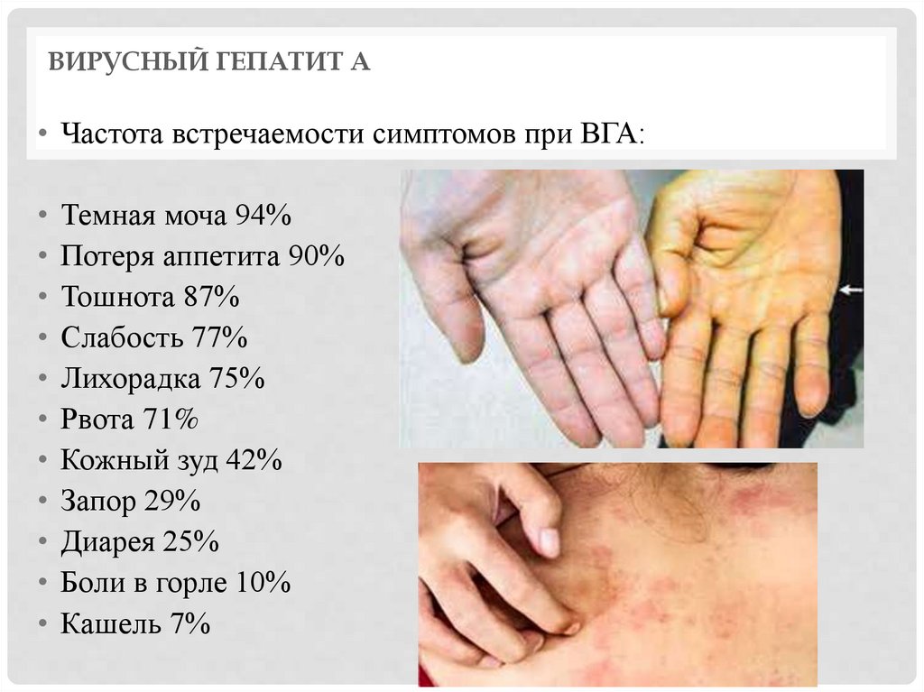 Вирусный гепатит А