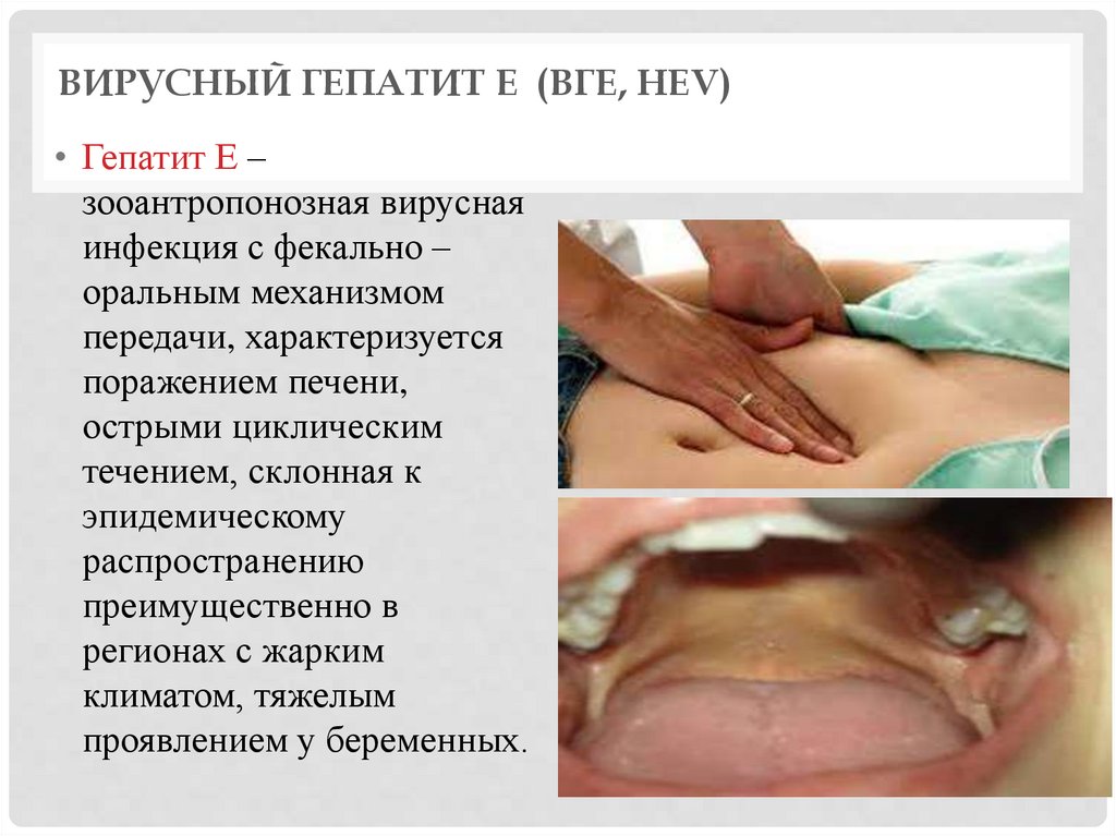 Вирусный гепатит Е (ВГЕ, HEV)