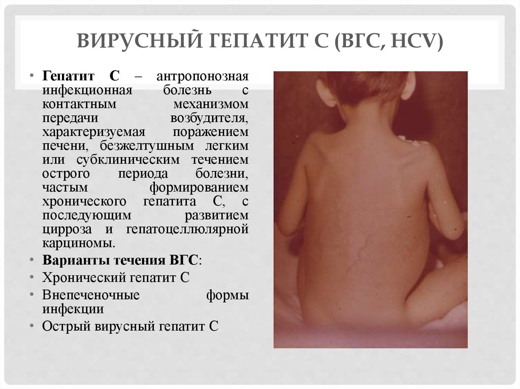 Вирусный гепатит В