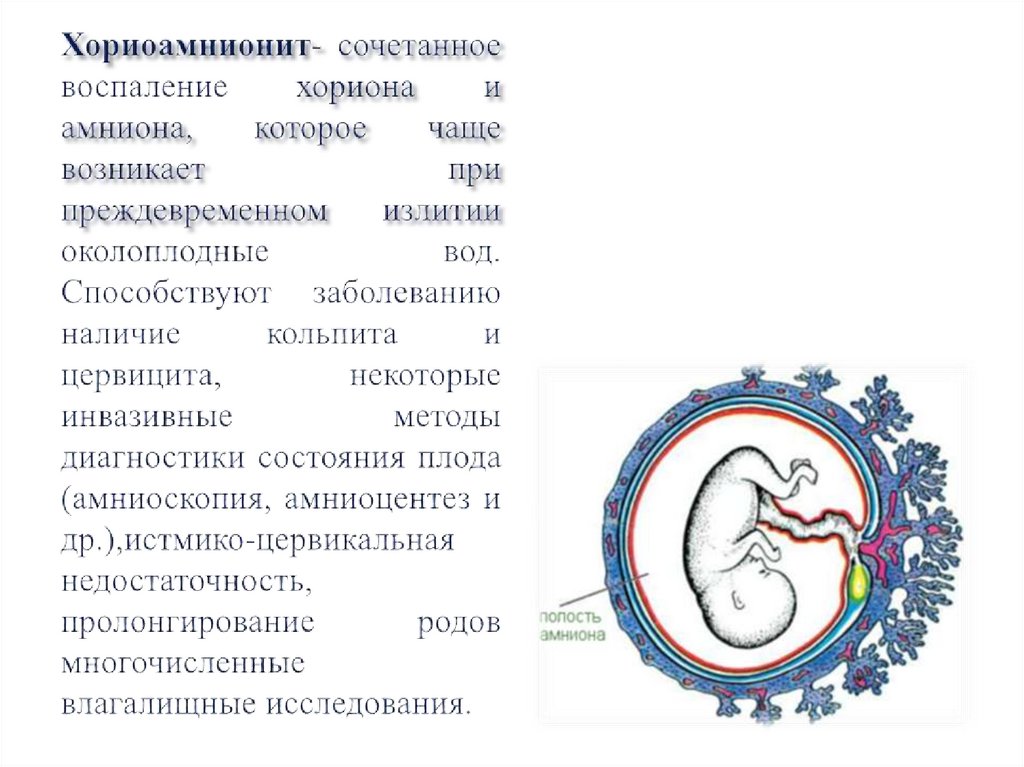 Хориоамнионит- сочетанное воспаление хо­риона и амниона, которое чаще возникает при преждевременном излитии околоплодные вод.