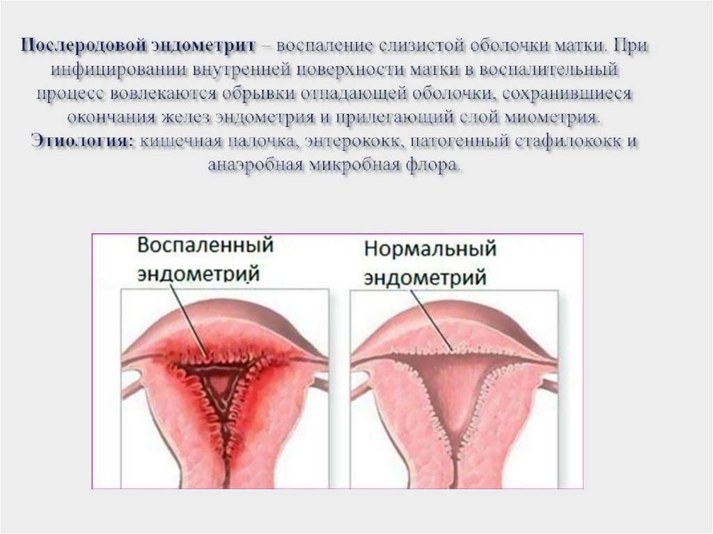 Послеродовой эндометрит – воспаление слизистой оболочки матки. При инфицировании внутренней поверхности матки в воспалительный