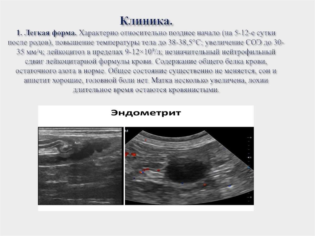 Клиника. 1. Легкая форма. Характерно относительно позднее начало (на 5-12-е сутки после родов), повышение температуры тела до