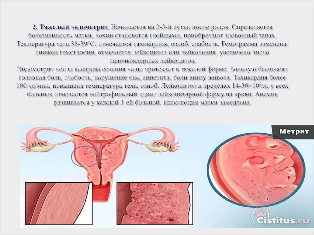 2. Тяжелый эндометрит. Начинается на 2-3-й сутки после родов. Определяется болезненность матки, лохии становятся гнойными,
