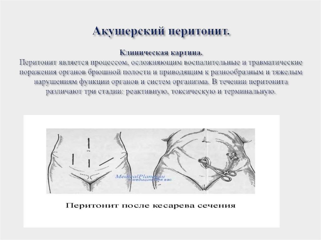 Акушерский перитонит. Клиническая картина. Перитонит является процессом, осложняющим воспалительные и травматические поражения