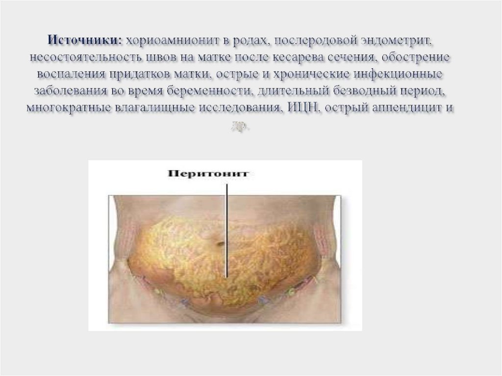 Источники: хориоамнионит в родах, послеродовой эндометрит, несостоятельность швов на матке после кесарева сечения, обострение