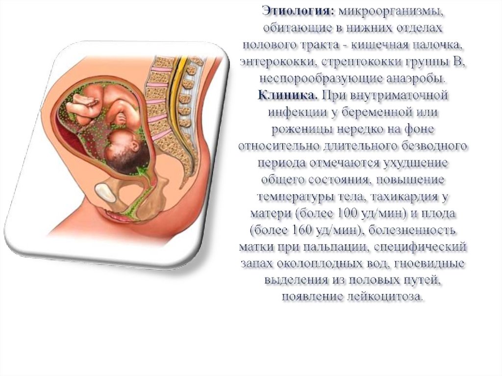 Этиология: микроорганизмы, обитающие в нижних отделах полового тракта - кишечная палочка, энте­рококки, стрептококки группы В,