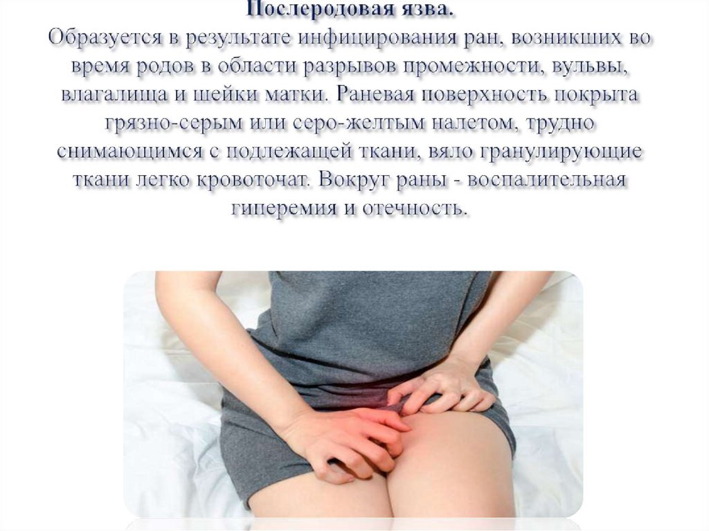 Послеродовая язва. Образуется в результате инфицирования ран, возникших во время родов в области разрывов промежности, вуль­вы,