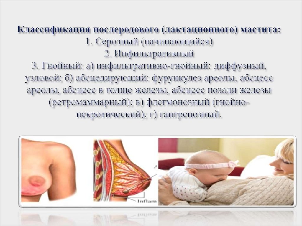 Классификация послеродового (лактационного) мастита: 1. Серозный (начинающийся) 2. Инфильтративный 3. Гнойный: а)