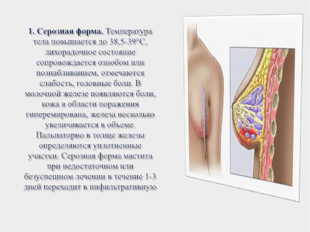 1. Серозная форма. Температура тела повышается до 38,5-39°С, лихорадочное состояние сопровождается ознобом или познабливанием,