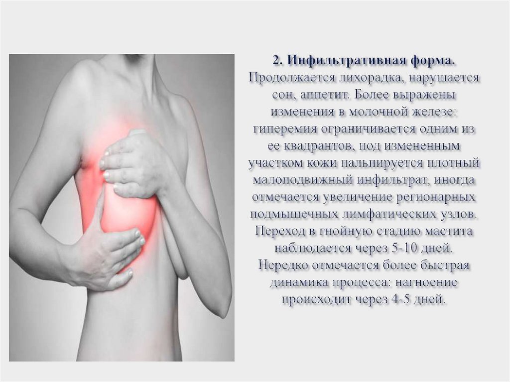 2. Инфильтративная форма. Продолжается лихорадка, нарушается сон, аппетит. Более выражены изменения в молочной железе: