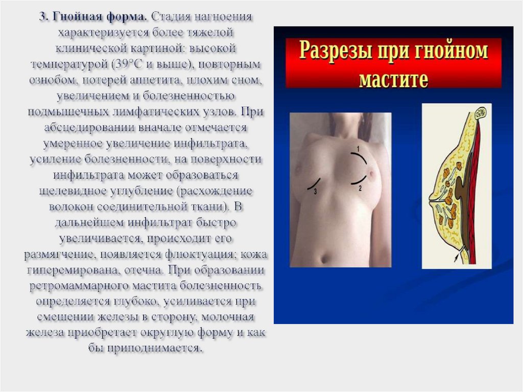 3. Гнойная форма. Стадия нагноения характеризуется более тяжелой клинической картиной: высокой температурой (39°С и выше),