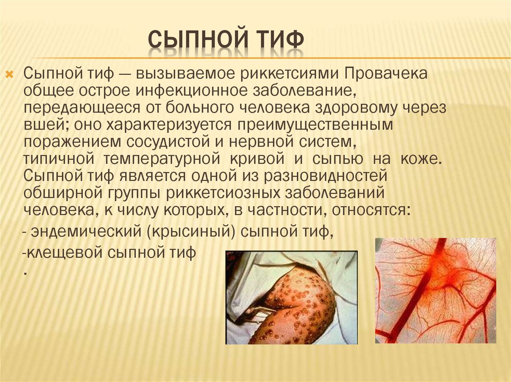 Сыпной тиф