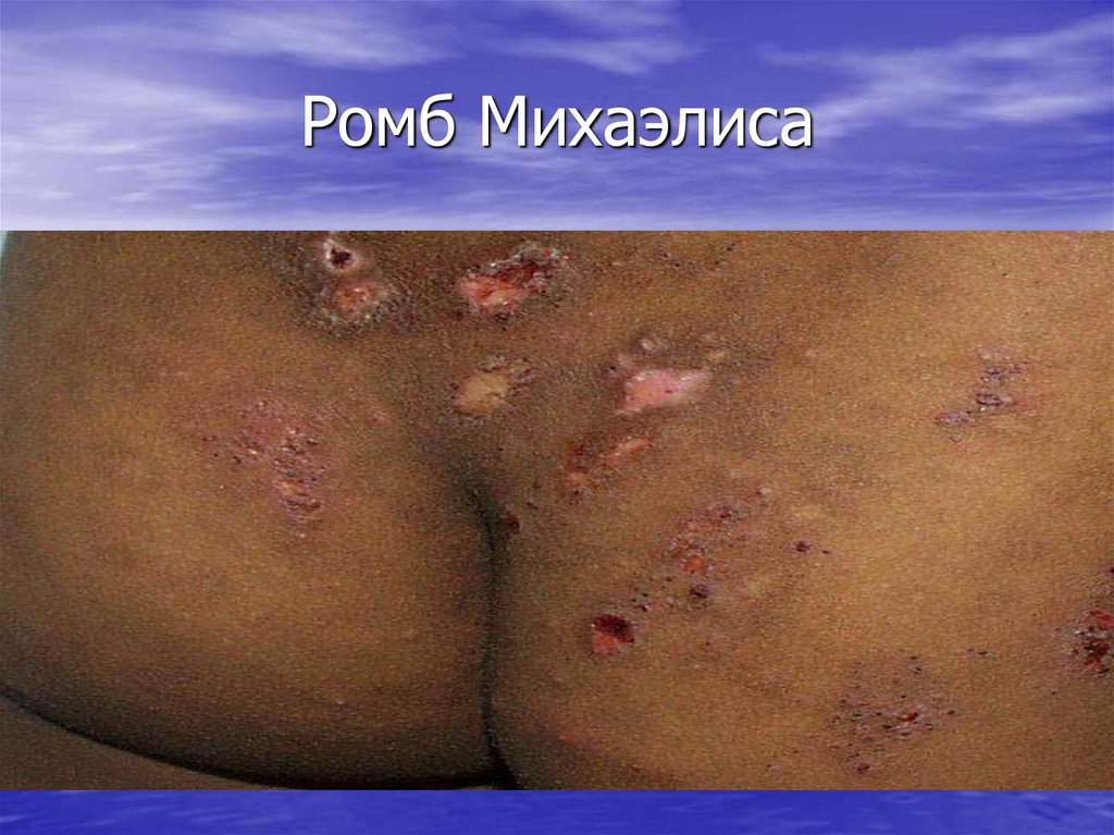 Ромб Михаэлиса