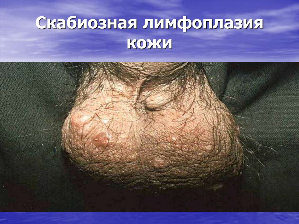 Скабиозная лимфоплазия кожи