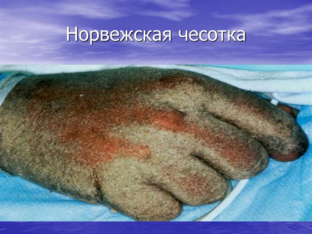 Норвежская чесотка