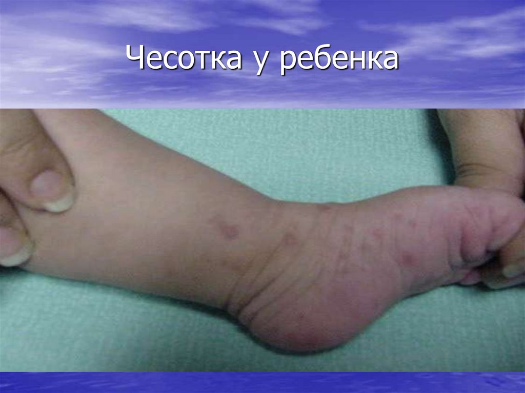 Чесотка у ребенка