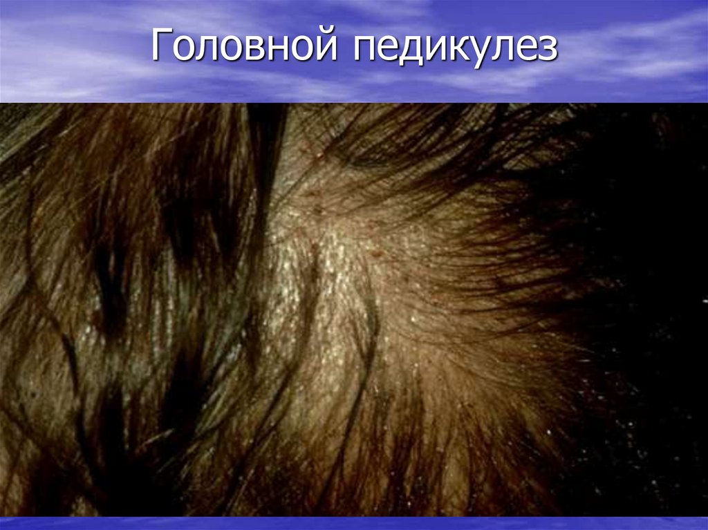 Головной педикулез