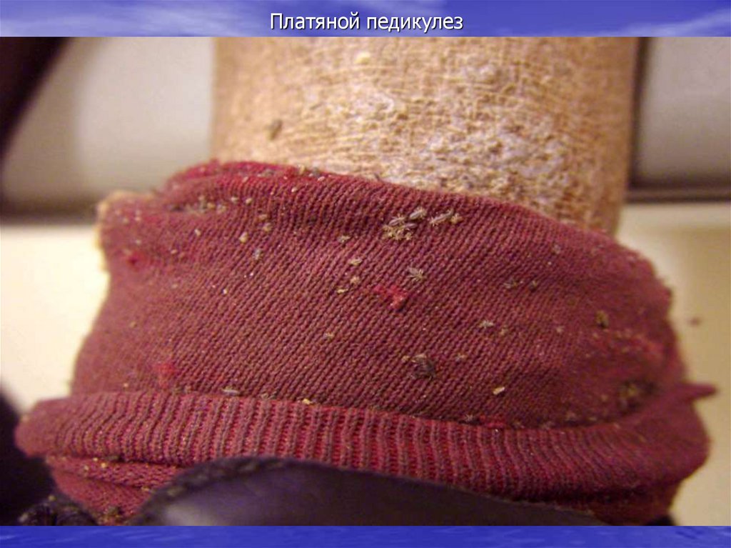 Платяной педикулез