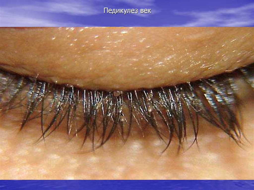 Педикулез век