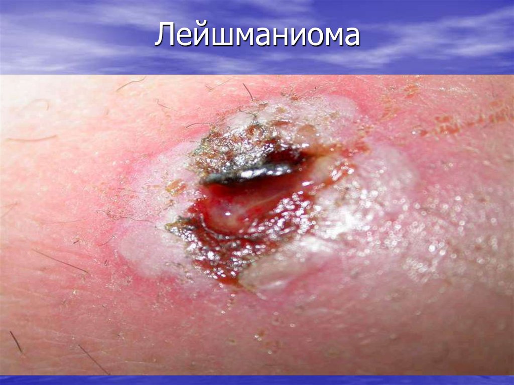 Лейшманиома