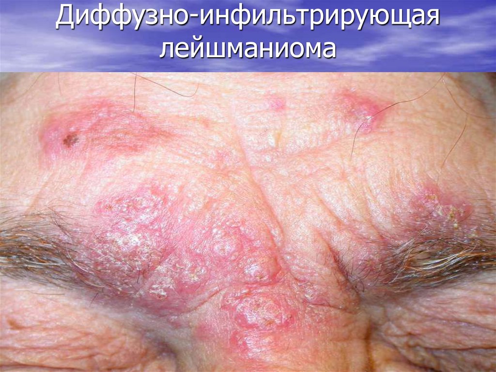 Диффузно-инфильтрирующая лейшманиома