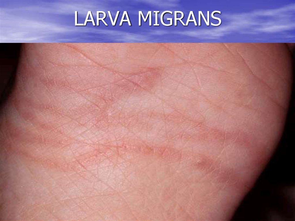 LARVA MIGRANS