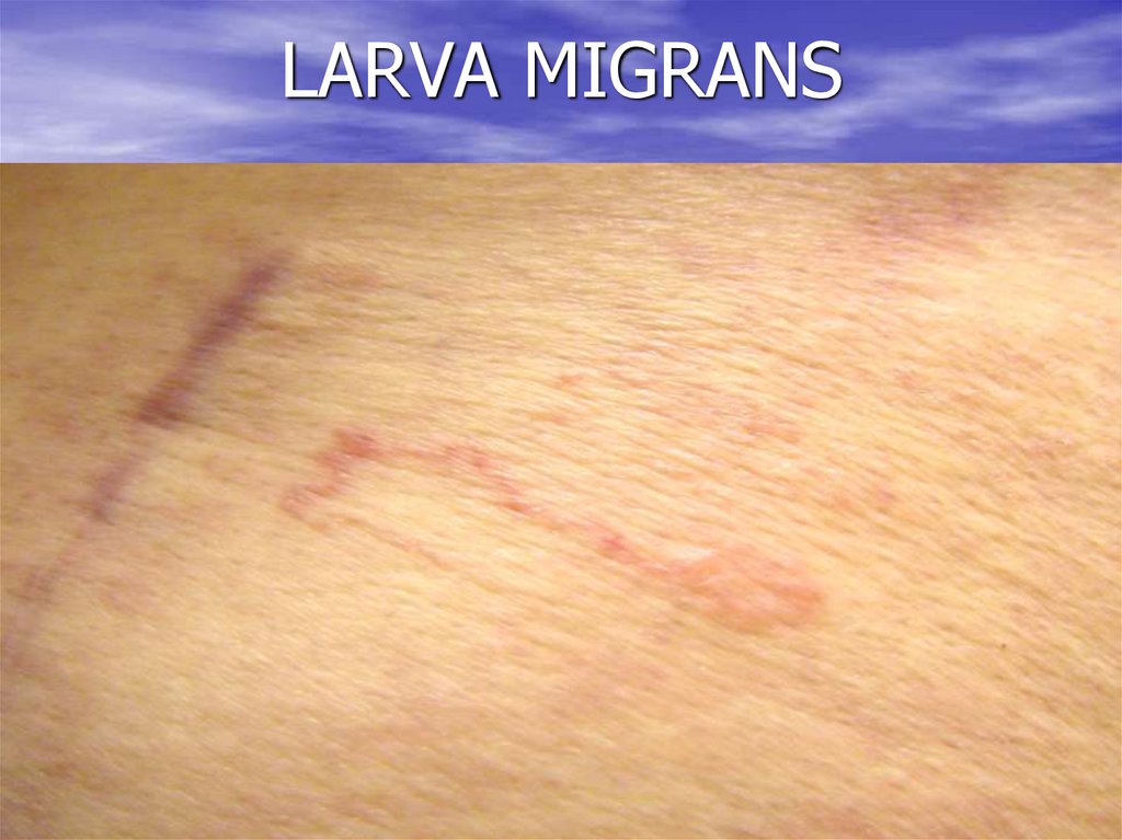 LARVA MIGRANS