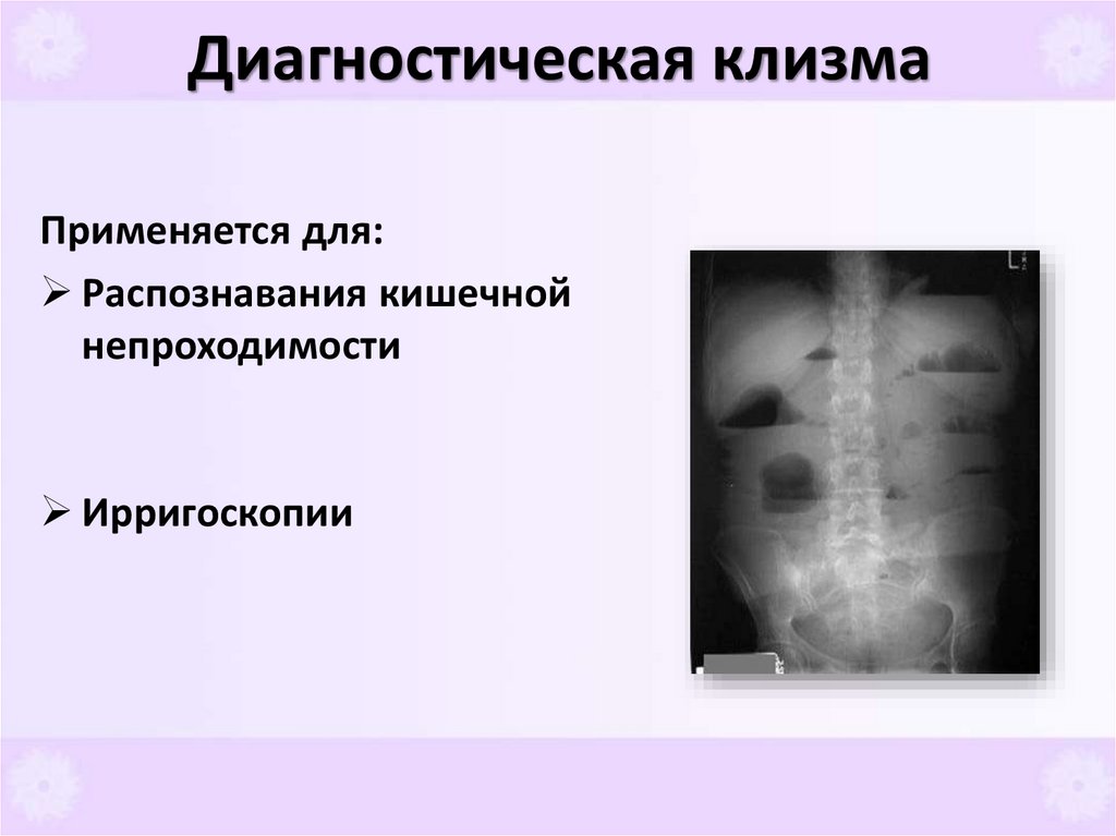 Диагностическая клизма