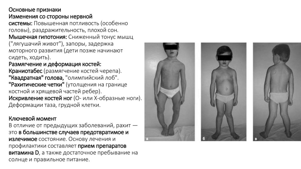 Основные признаки Изменения со стороны нервной системы: Повышенная потливость (особенно головы), раздражительность, плохой сон.