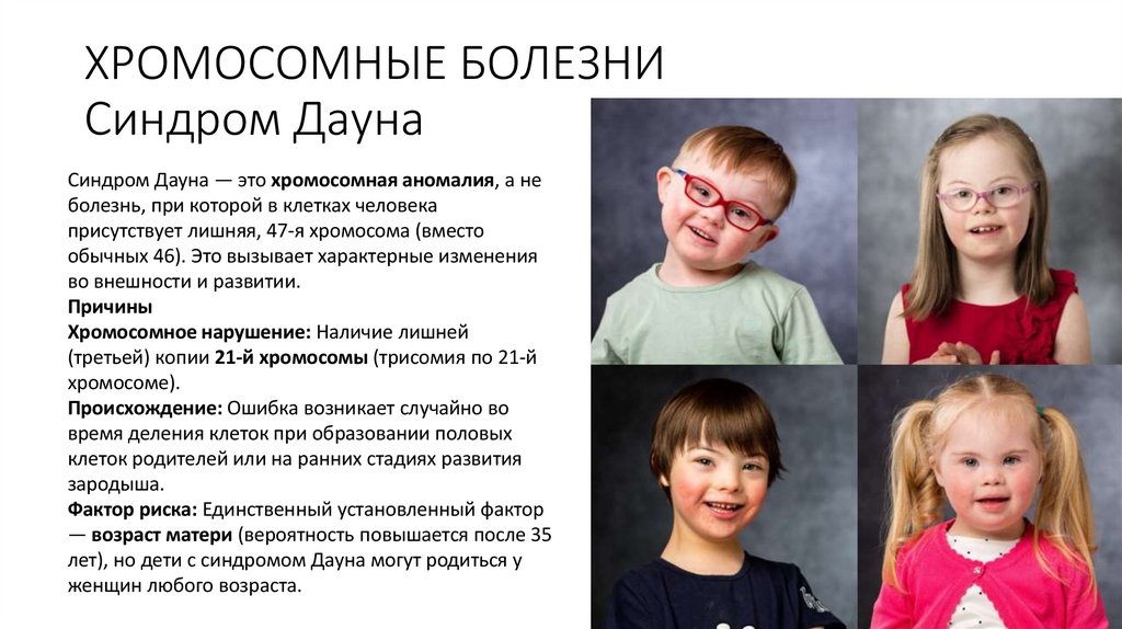 ХРОМОСОМНЫЕ БОЛЕЗНИ Синдром Дауна
