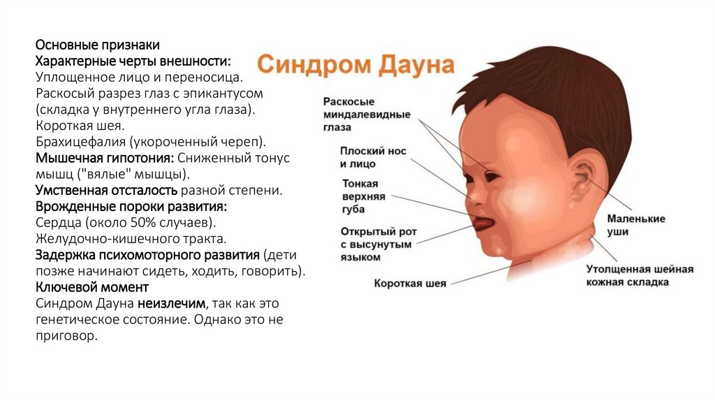 Основные признаки Характерные черты внешности: Уплощенное лицо и переносица. Раскосый разрез глаз с эпикантусом (складка у