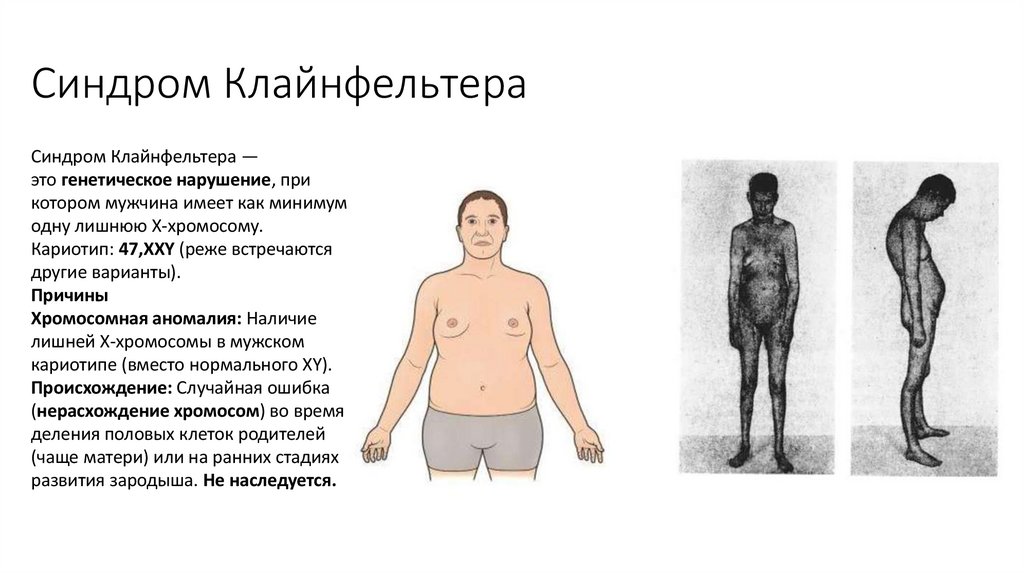 Синдром Клайнфельтера