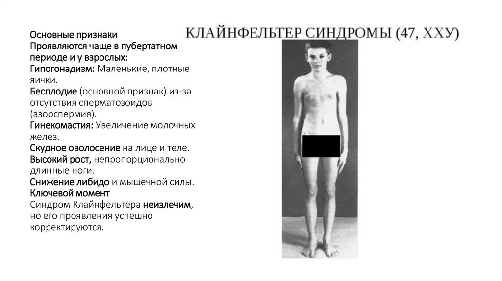 Основные признаки Проявляются чаще в пубертатном периоде и у взрослых: Гипогонадизм: Маленькие, плотные яички.