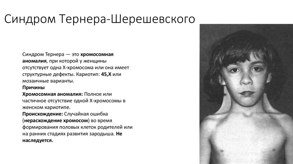 Синдром Тернера-Шерешевского