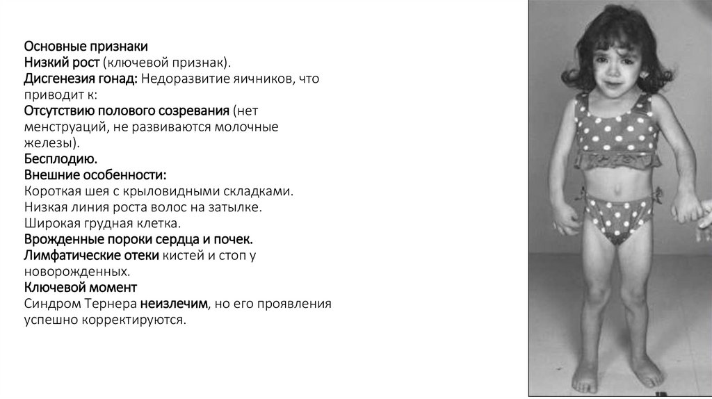 Основные признаки Низкий рост (ключевой признак). Дисгенезия гонад: Недоразвитие яичников, что приводит к: Отсутствию полового