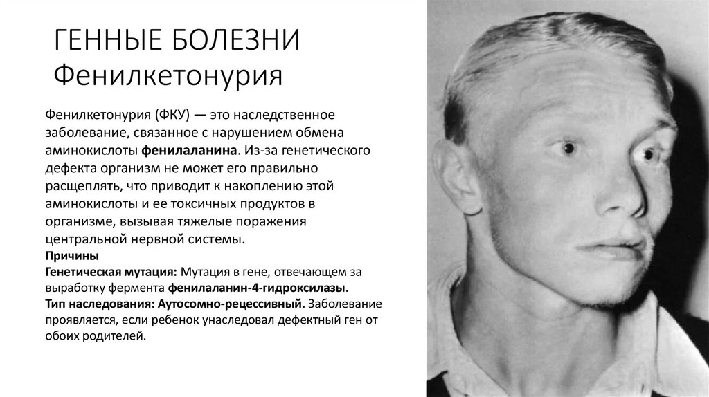 ГЕННЫЕ БОЛЕЗНИ Фенилкетонурия