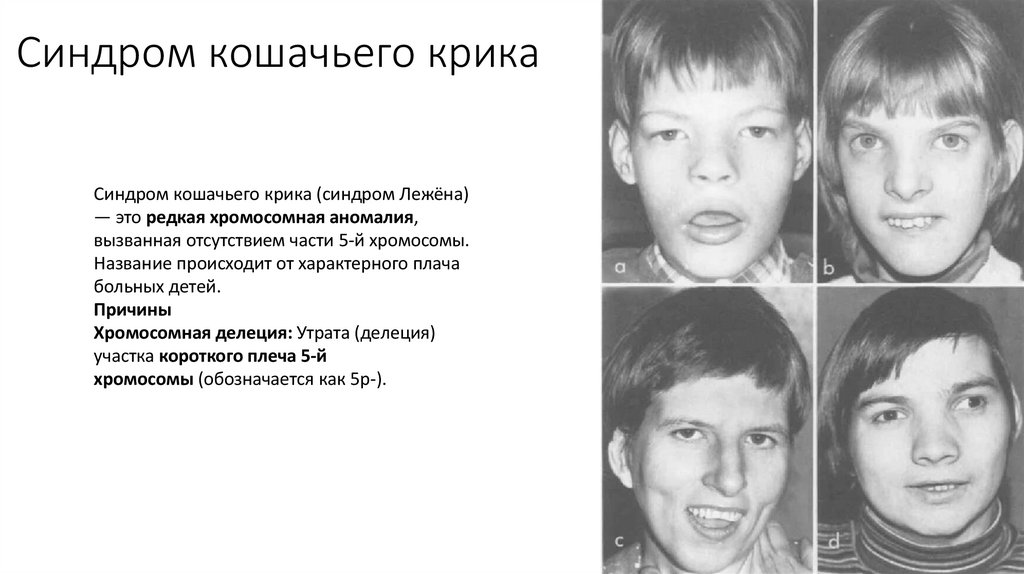 Синдром кошачьего крика