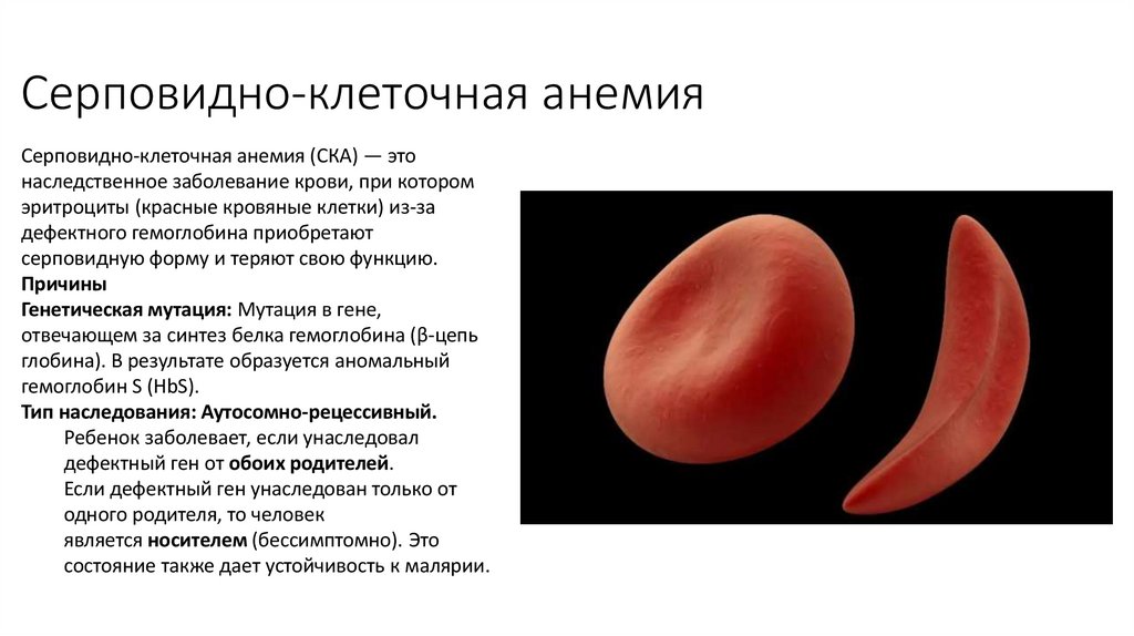 Серповидно-клеточная анемия